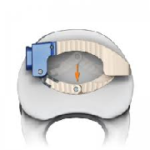 LONGBOW Expandable Lateral Spacer System