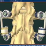Stabilimax Dynamic Spine Stabilization System
