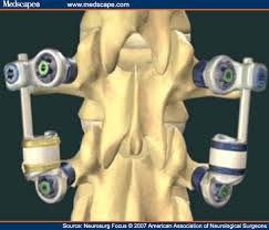 Stabilimax Dynamic Spine Stabilization System