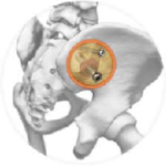 SImmetry Sacroiliac Joint Fusion System