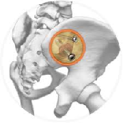SImmetry Sacroiliac Joint Fusion System
