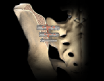 TriCor Sacroiliac Joint Fusion System