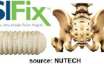 SIFIX Intra-Articular System
