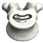 Tyber Medical TLIF