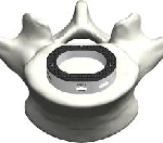 Tyber Medical ALIF