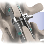 Reli™ SP Spinous