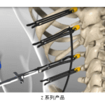 ZINA MIS Spine System