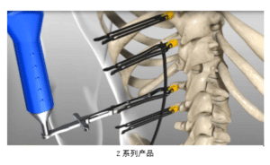 ZINA MIS Spine System