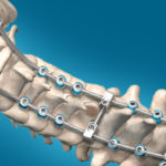 Centurion Posterior Occipital Cervico-Thoracic (POCT) ​System