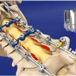 Proficient® Posterior Cervical Spine System