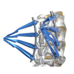 NOVA Minimal Invasive System