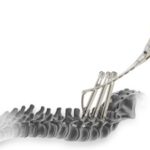 medtronic horizon solera
