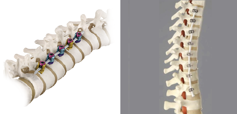 Vertebral Body Tethering