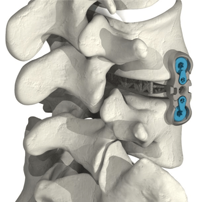 4WEB Medical Receives 510(k) Clearance for its Lumbar Plating Solution ...