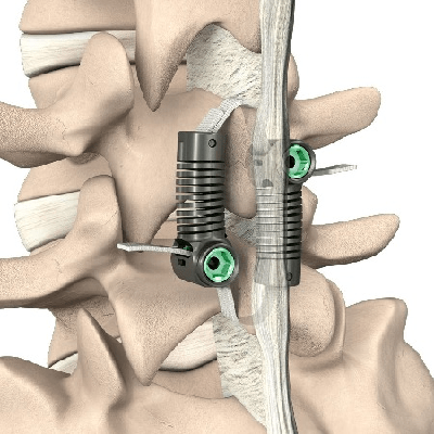 Empirical Spine Advances Limiflex™ as a New Motion-Preserving ...