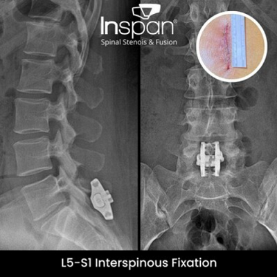 Revolutionizing Spine Surgery Techniques InSpan Publishes First L5 S1 Spinal Fixation Research