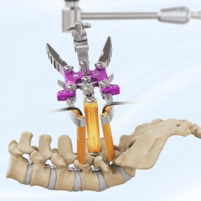 TeDan Surgical Innovations Launches Phantom ML3™ MIS Lumbar
